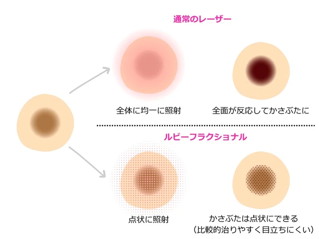 図解 通常レーザーとルビーフラクショナルの違い