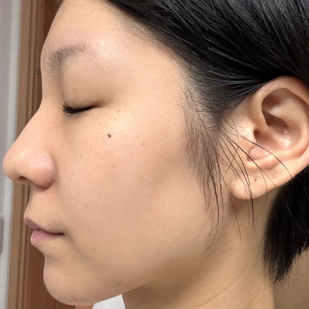 【エリシスセンス体験ブログ】ダウンタイムの経過は?3回施術後の効果を徹底検証!_15