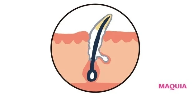 【顔の角質ケア】「つまり毛穴」のお悩みにおすすめの角質ケア_白つまり毛穴イメージ