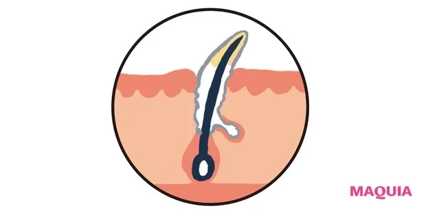 「つまり毛穴」を引き起こす5つの主な原因_4.白角栓が固まってしまっている