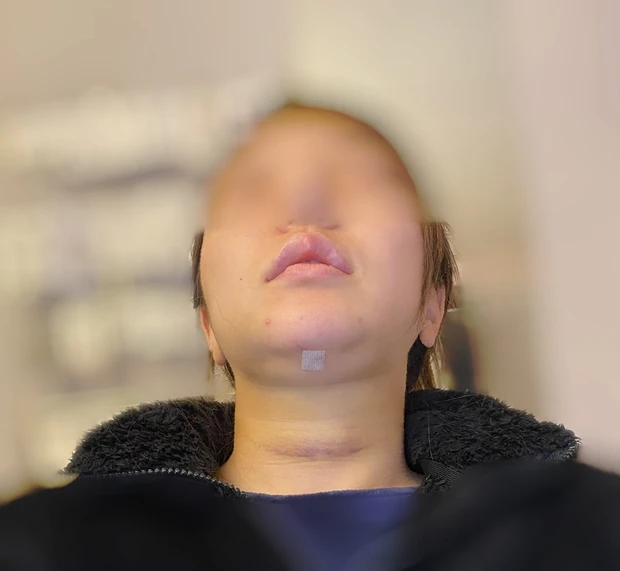 【顎下脂肪吸引受けてきました②】手術前〜1週間の経過記録ダウンタイムまとめ_3