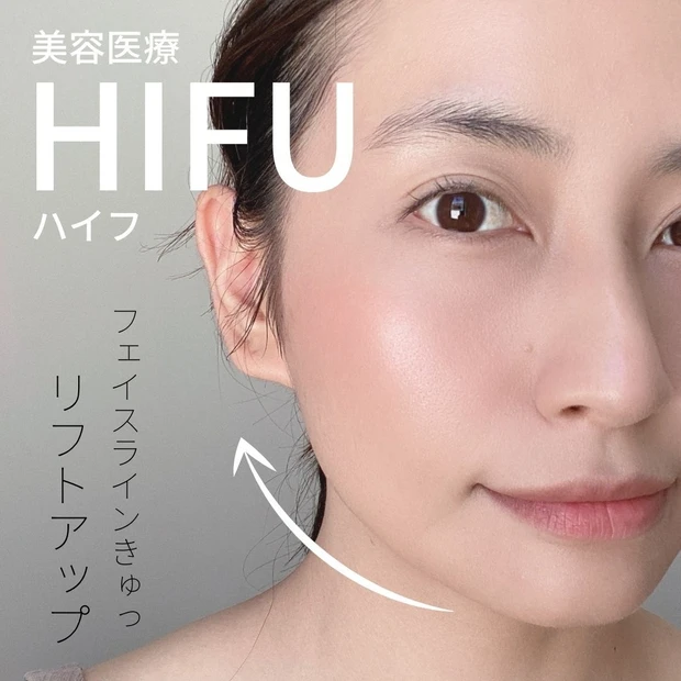 【2021年総まとめ】今年受けた美容医療!徹底解説!_5_2