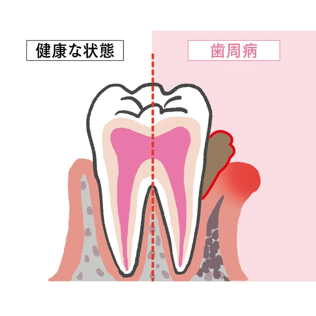 【40代からの歯活】歯周病はエアロゾルや唾液でも感染? 治療の最前線を解…