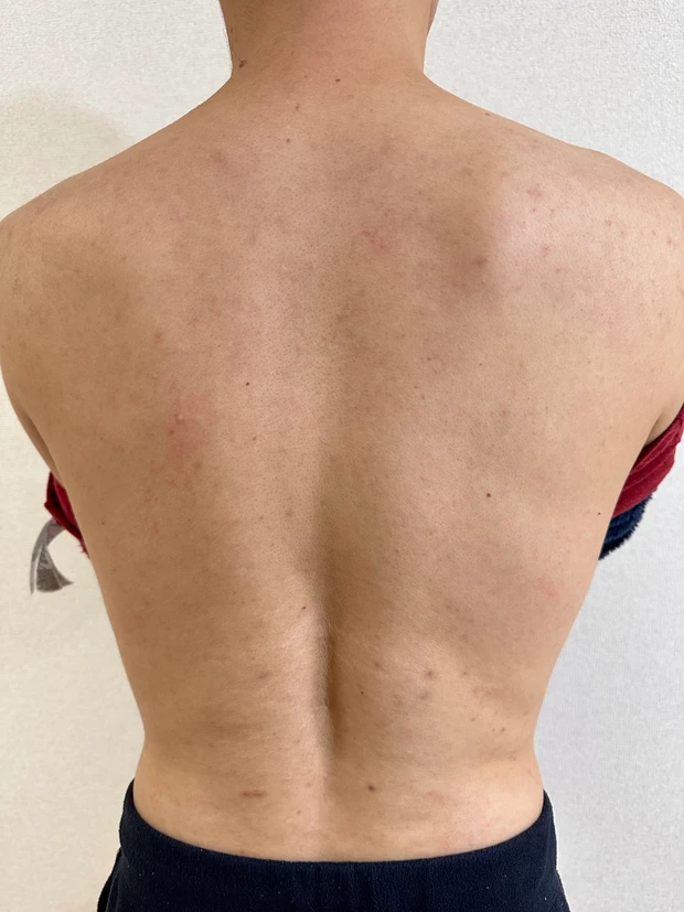 【リファファインバブル S】を使ったら、その後どうなった?パパの背中ニキビ激減。〜4ヶ月後〜_2_2