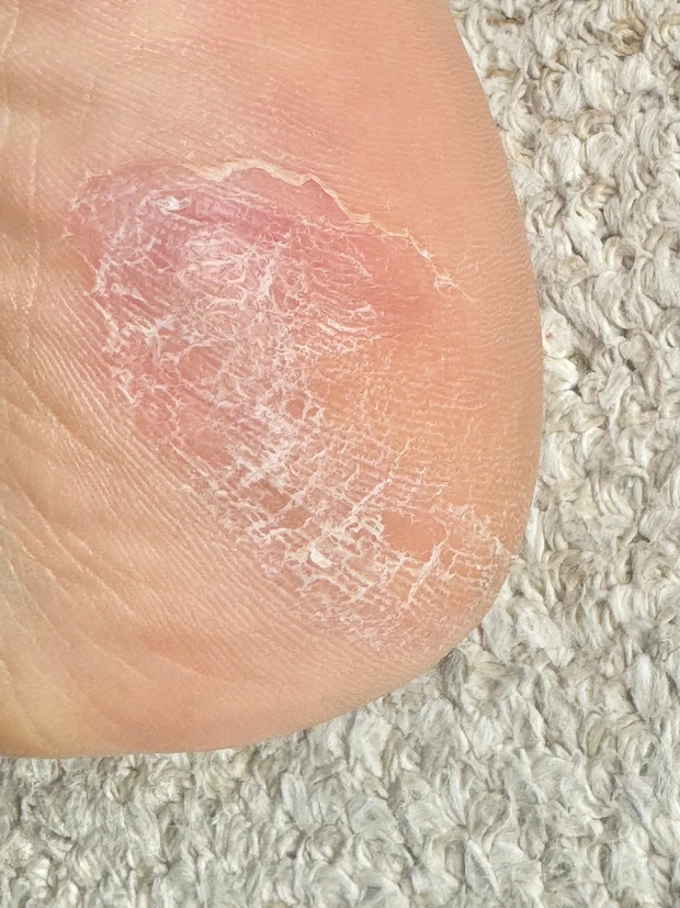 ガサガサかかと　かかと　角質ケア