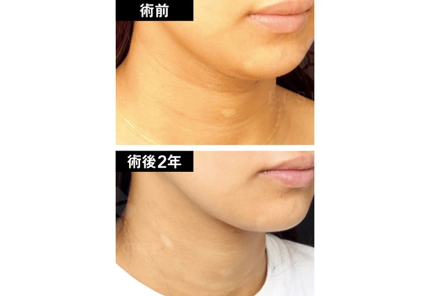 術前　術後2年