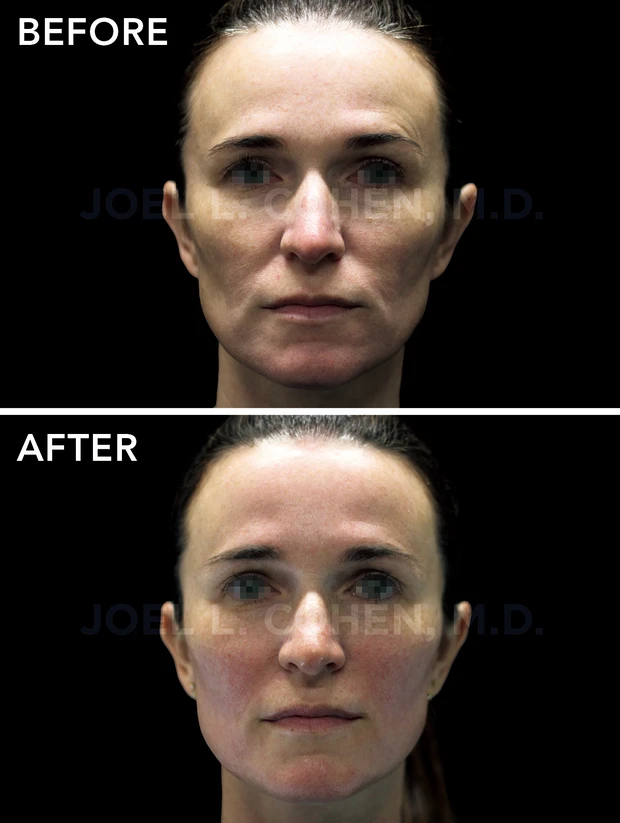 美容家 大野真理子さん おすすめのサロン施術 クリニックKで自然にリフトアップ