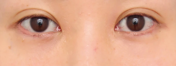 茶くまにおすすめの美容医療の治療 ハムラ法 アフター 3か月後