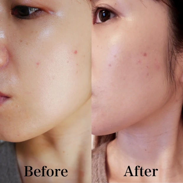 【ニキビ】30代大人ニキビの皮膚科での治療法＊定期的なメンテナンスを！_2