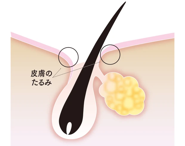 毛穴がたるむ原因とは?