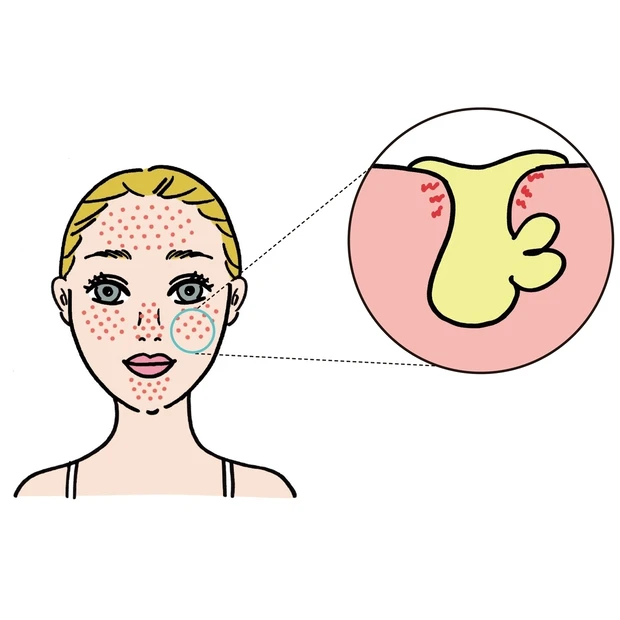 皮脂過多が原因の「開き毛穴」を引き締める極意。まずは混合肌か脂性肌を見極…