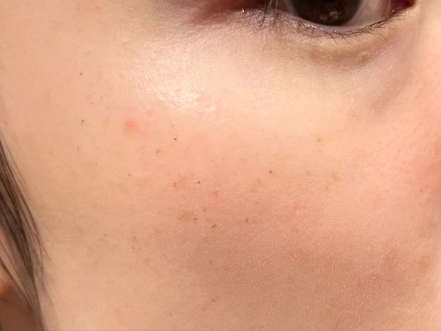 ルメッカ照射後