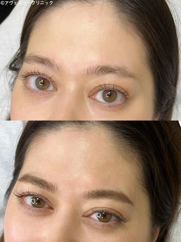 アヴェニュークリニック アートメイク アイブロウ症例写真2aib