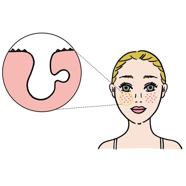 毛穴がパックリな「開き毛穴」を解決するには？ 決め手は、保湿・巡り・肌再…