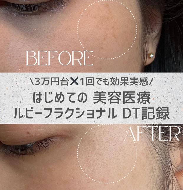 【3万円台✖️1回でも効果実感】はじめての美容医療。ルビーフラクショナルDT記録。_1