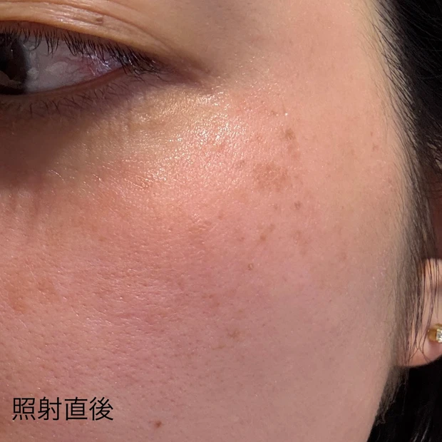 ルビーフラクショナル 施術直後