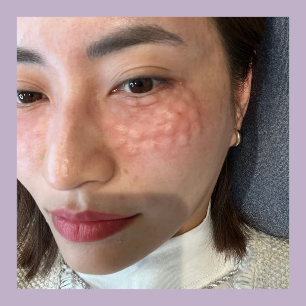 【美容医療】肌の内部、真皮に効果がある治療を美容クリニックカウンセラーが解説します！_4