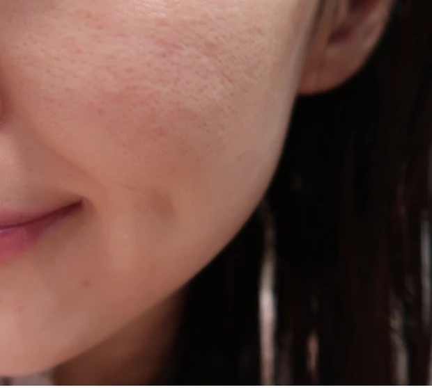 【美容皮膚科】ピコトーニング_1_2