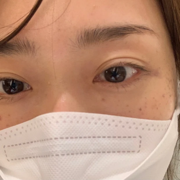 【ご当地美容】上海のヨセミテクリニックでM22(IPL治療)を受けてみた！6回コースでシミそばかすに効果あり！_6_1