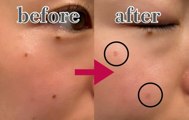 ホクロ除去後　炭酸レーザー