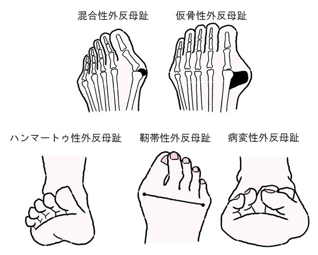 【外反母趾の原因と正しい対策】Q 外反母趾とはどのような症状のこと?