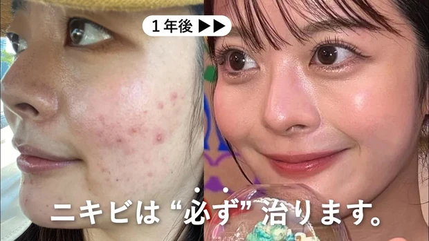 ももち　牛江桃子　マキアTOPビューティーズ　ニキビ肌　ニキビ肌の治し方
