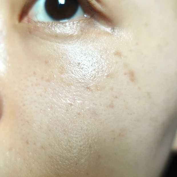 【ご当地美容】上海のヨセミテクリニックでM22(IPL治療)を受けてみた！6回コースでシミそばかすに効果あり！_9_1