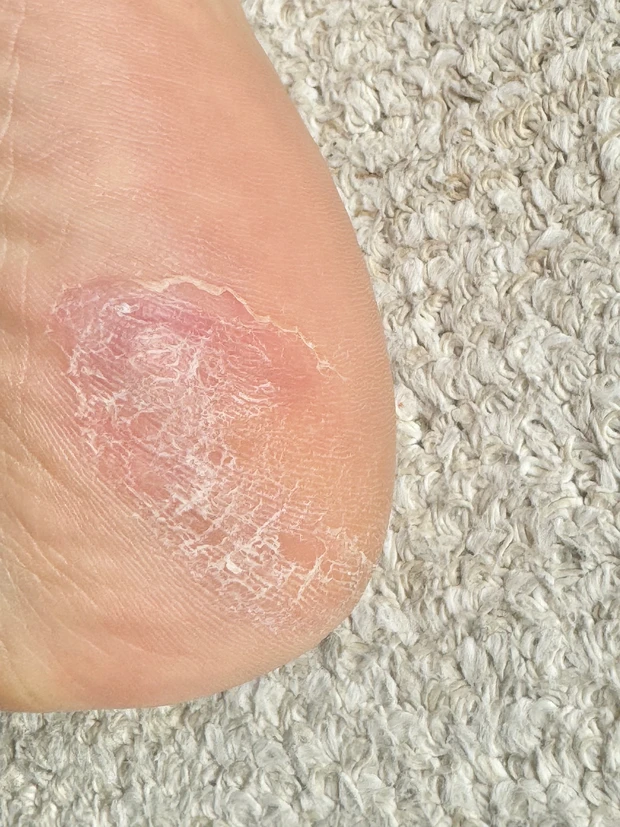 【検証】オルビスのディフェンセラでガサガサかかとがつるんとなるまでの4ヶ月を記録！_5_1