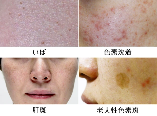 いぼ色素沈着肝斑老人性色素斑
