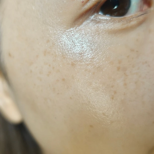 【ご当地美容】上海のヨセミテクリニックでM22(IPL治療)を受けてみた！6回コースでシミそばかすに効果あり！_3_2