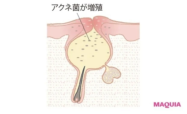 【マスクニキビの原因1】摩擦_毛穴イラスト2