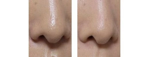 鼻のメイク落ちのリペアbefore＆after