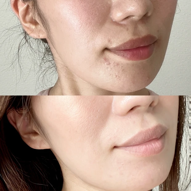 マスクニキビ大丈夫？話題の赤いスキンピールバーで効果が出たよ♡皮膚科ドクターおすすめの３stepニキビケア教えちゃいます！_4