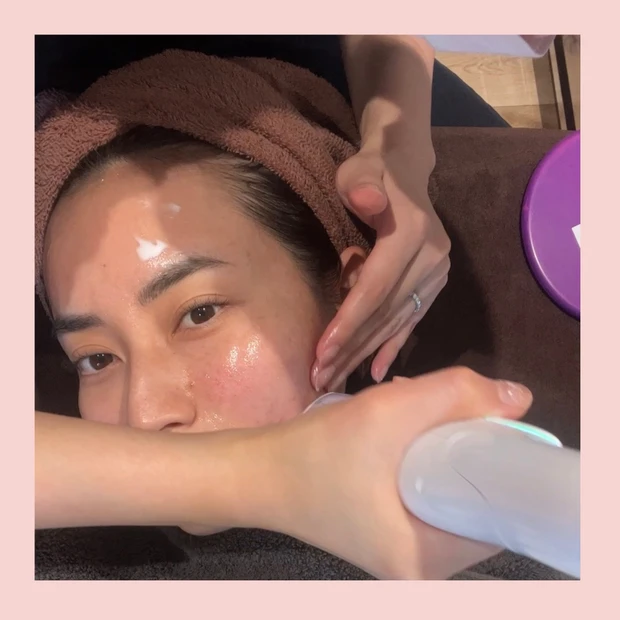 【美容医療】肌の内部、真皮に効果がある治療を美容クリニックカウンセラーが解説します！_2