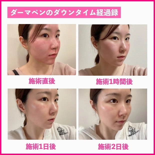 ダーマペン 施術後 経過