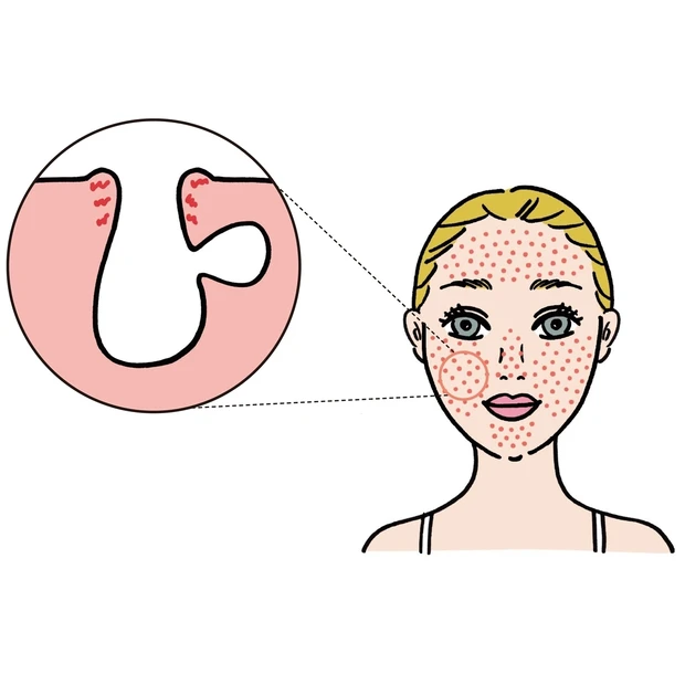 「ダメージが原因の開き毛穴」の正解ケア。ドクターが原因とお手入れ法をアド…