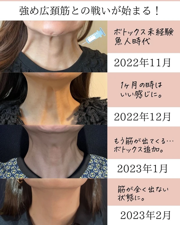 広頚筋ボトックス_リフトアップボトックス