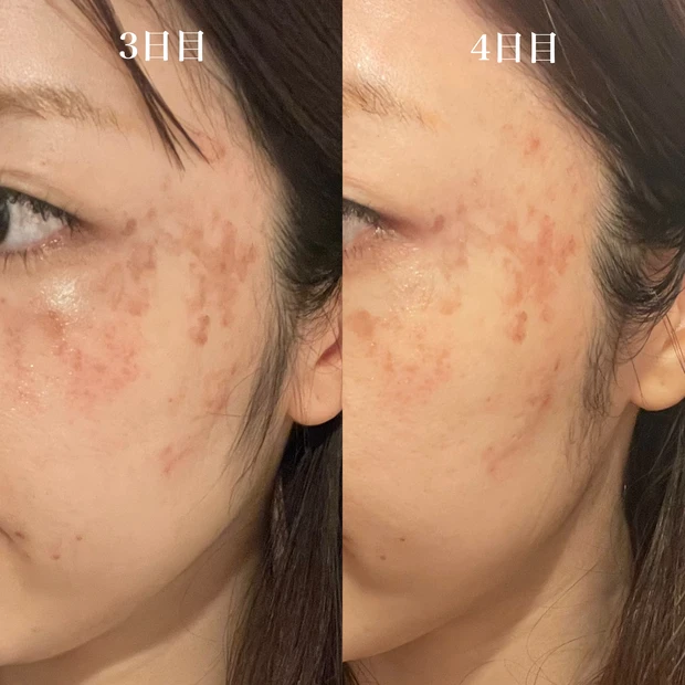 シミ取りレーザー　ダウンタイム　ブログ