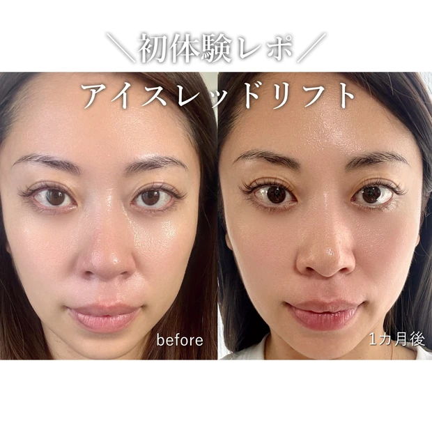【体験レポ】やってよかった！初心者におすすめ！ナチュラルに仕上がる「糸リフト（スレッドリフト）」経過・クリニック紹介