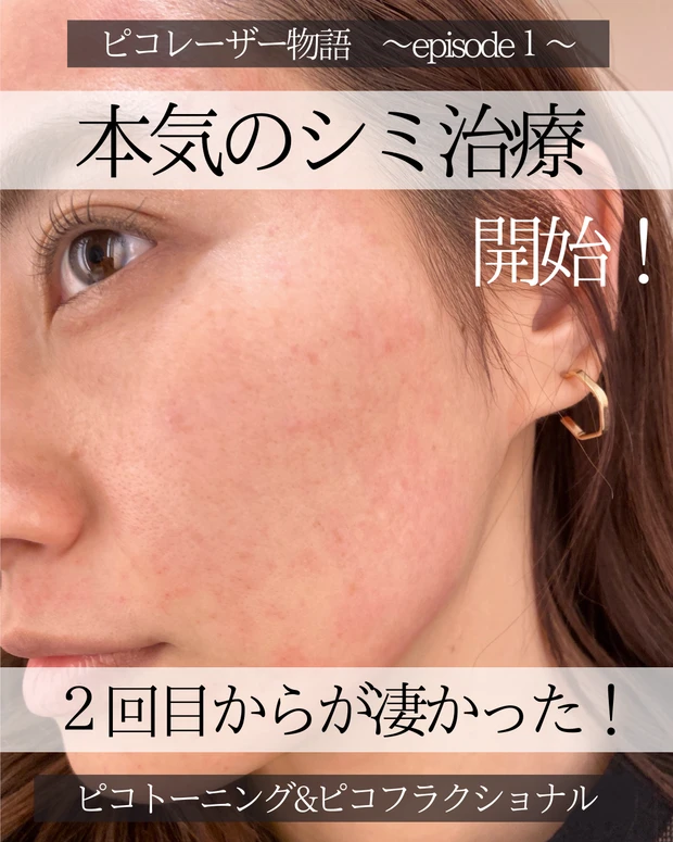 【2021年総まとめ】今年受けた美容医療!徹底解説!_7_2