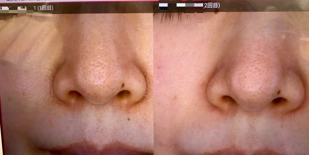 【30代で美容医療デビュー2】カスタマイズレーザー治療[２回目］施術1ヶ月後の結果レポート_3
