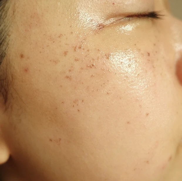 【ご当地美容】上海のヨセミテクリニックでM22(IPL治療)を受けてみた！6回コースでシミそばかすに効果あり！_5_2