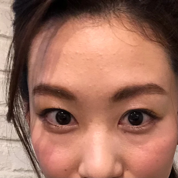 肌荒れ　人物写真　ニキビ