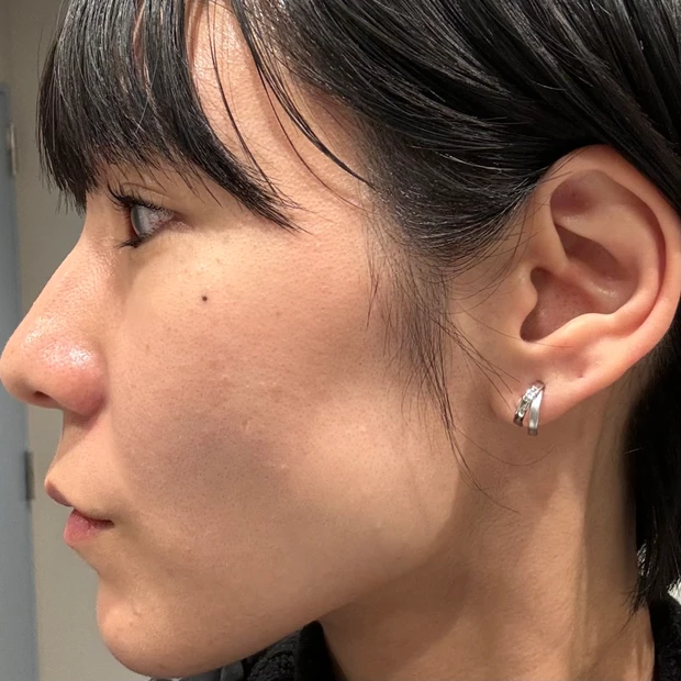 エリシスセンス 施術前