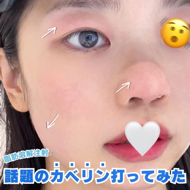 【美容医療】小鼻を小さくしたい！カベリン(脂肪溶解注射)打ってみました📝