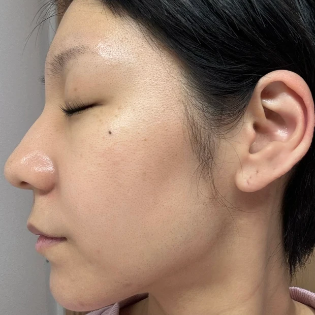 エリシスセンス ダウンタイム 7日目 経過