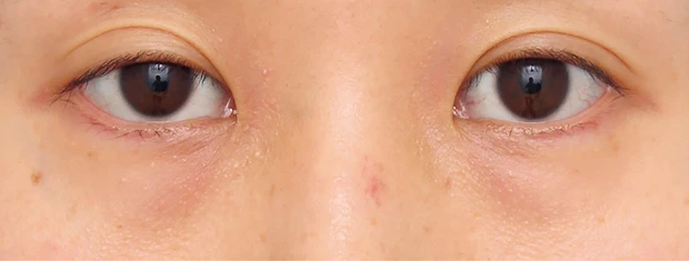 茶くまにおすすめの美容医療の治療 ハムラ法 ビフォー