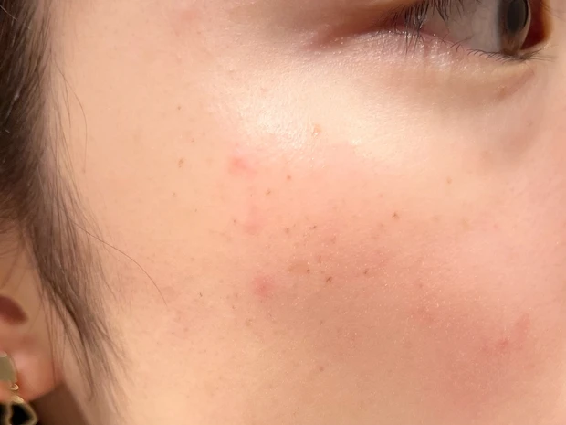 ルメッカ照射後