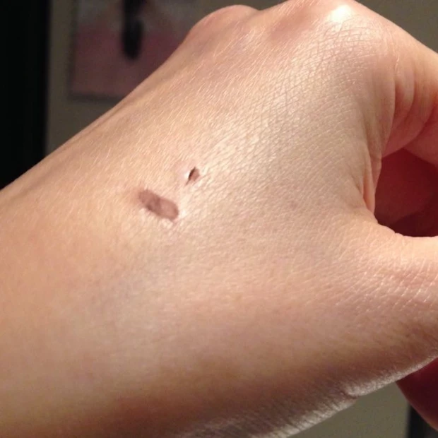 あの三年前のシミ、どうなった?!皮膚科のレーザーで剥がれた後、ビフォーアフターの写真。