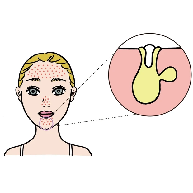 皮脂過多が原因の「詰まり毛穴」解決レシピ。皮脂コントロール＆食生活も見直…
